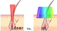 Depilación Láser IPL